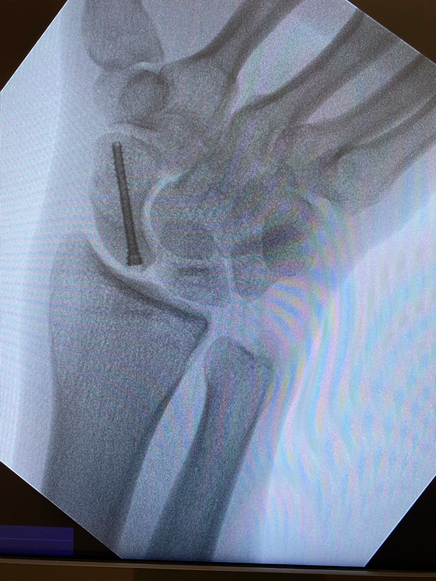 Exemplo de fixação de fratura de escafóide