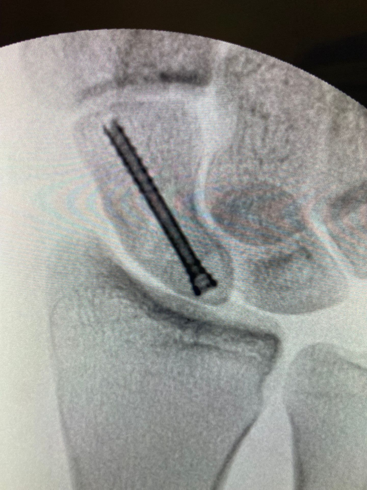 Outro exemplo de fixação de fratura de escafóide