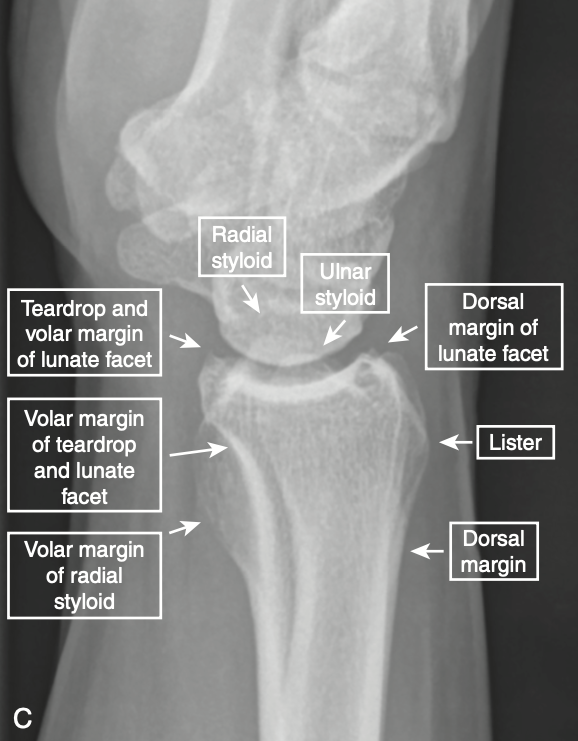 processo estilóide ulnar