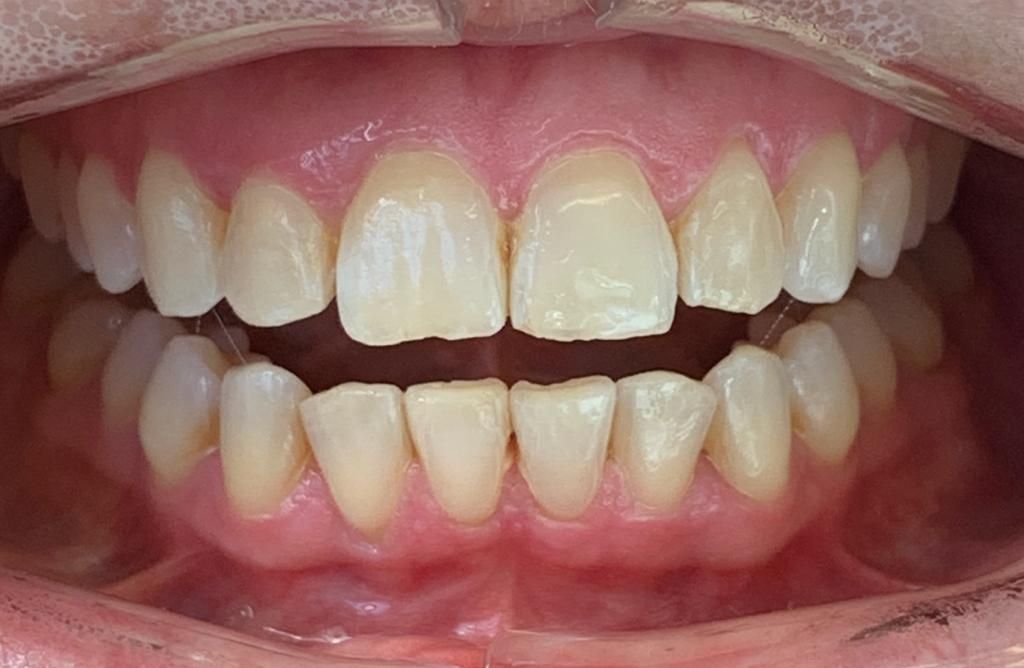 Invisalign Crowding After