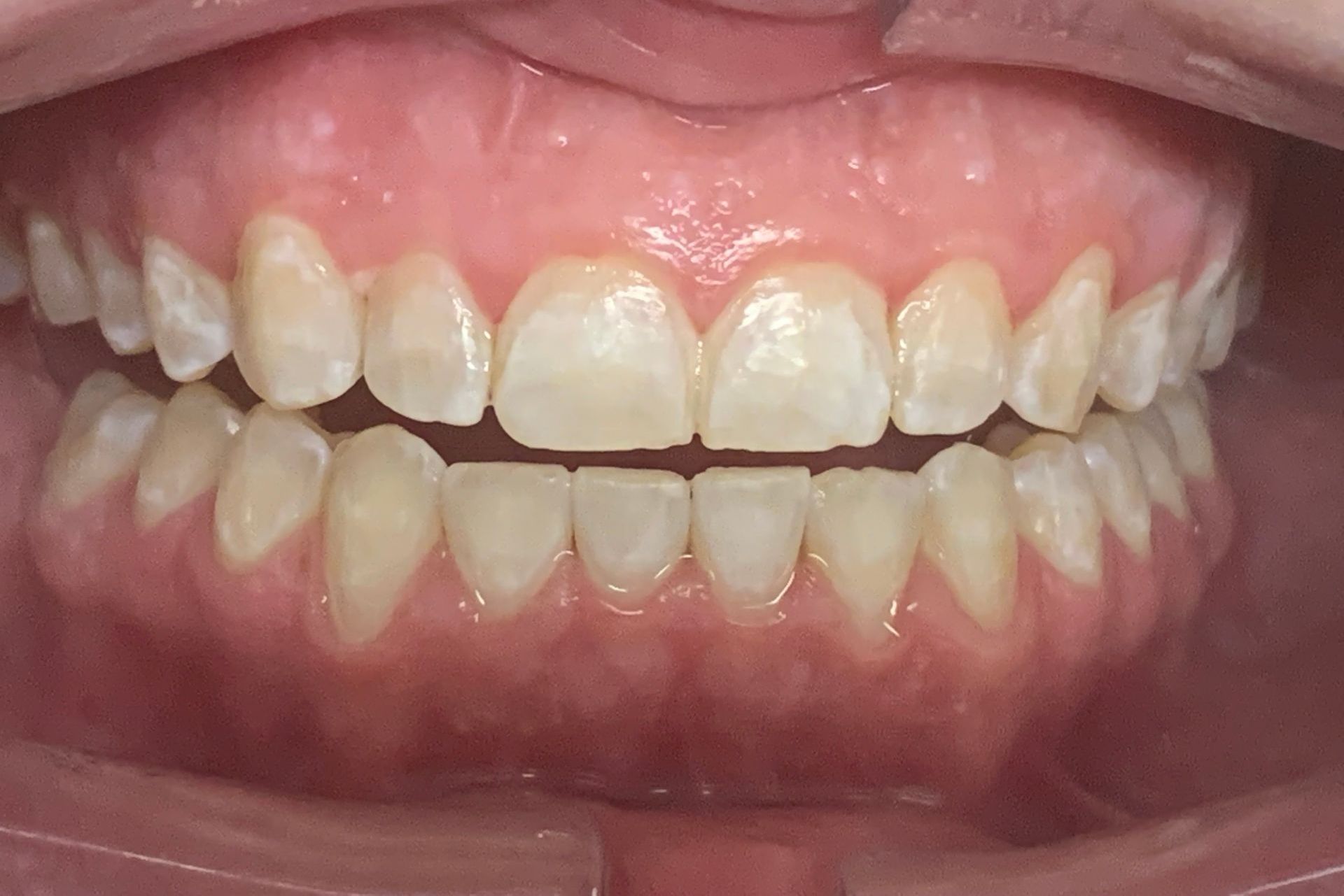 Invisalign Crowded Bottom After
