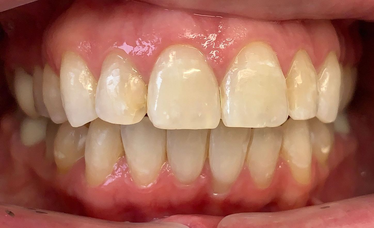 Invisalign Severe Crowding After
