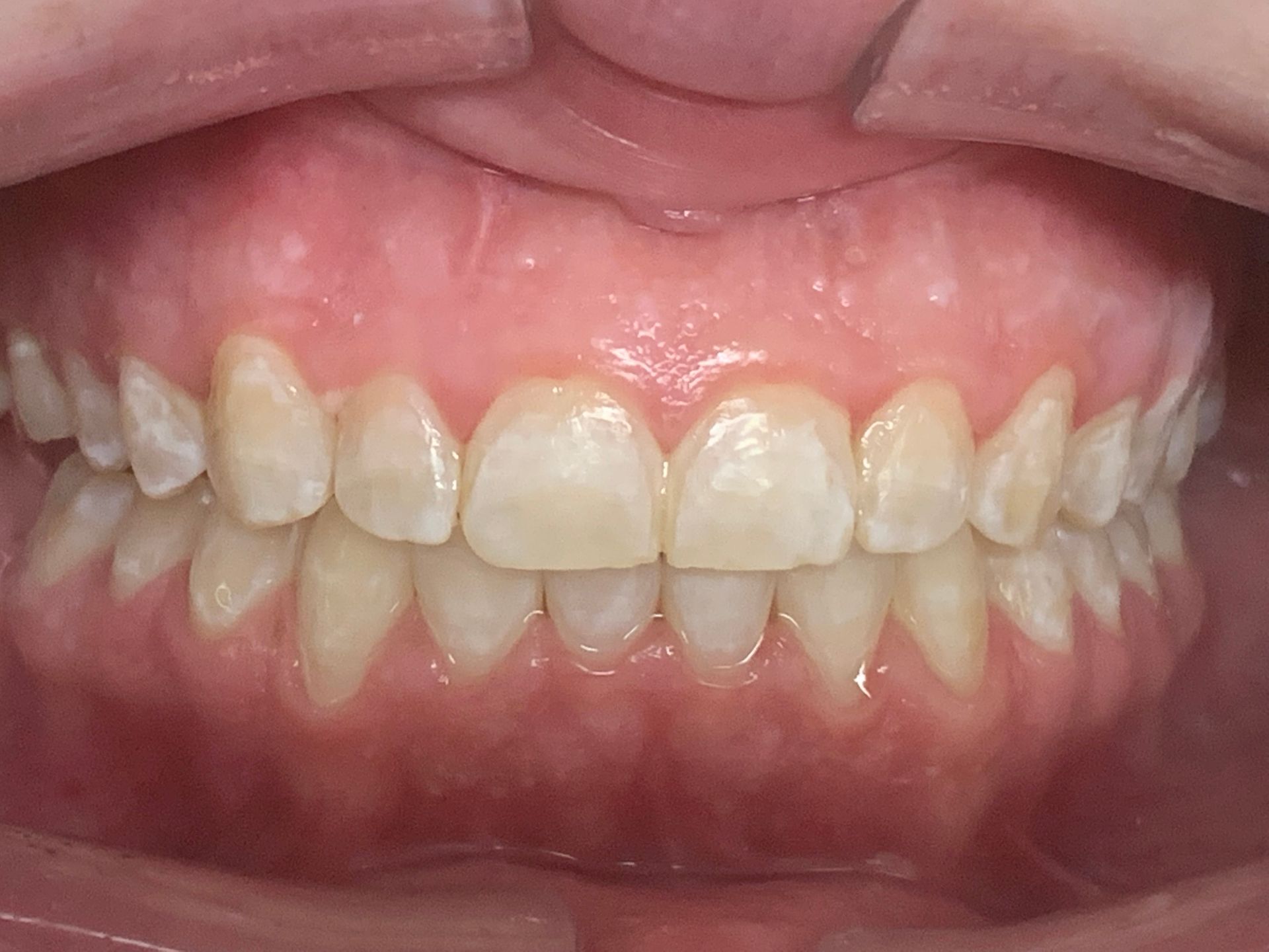 Invisalign Spacing After