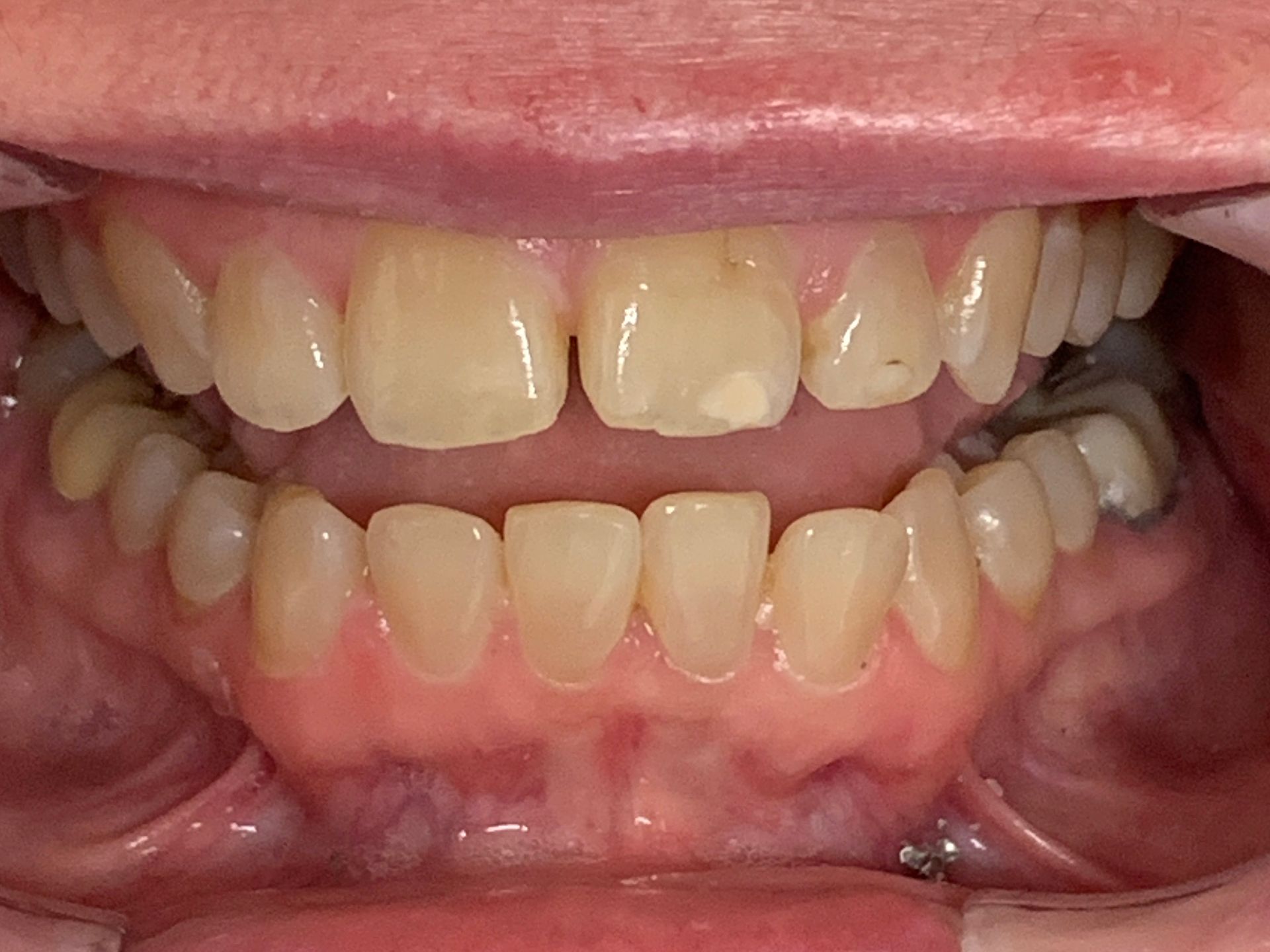Invisalign Crowded Bottom Before