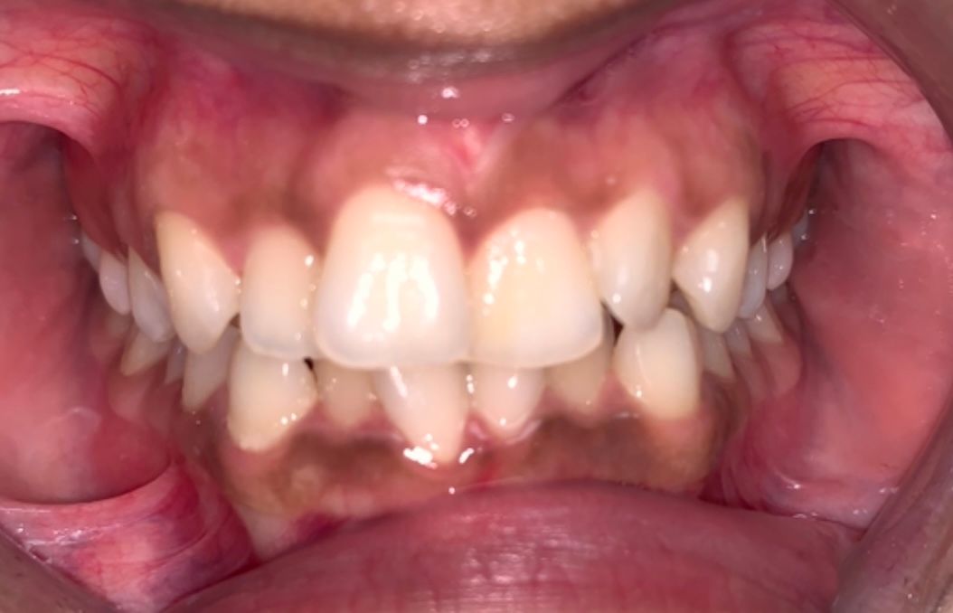 Invisalign Crowding Before