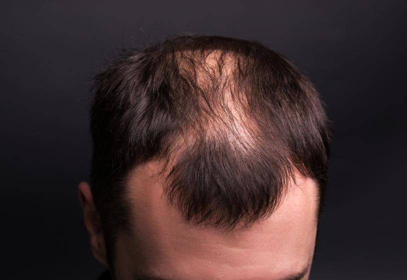 5 possibili soluzioni al diradamento dei capelli senza caduta