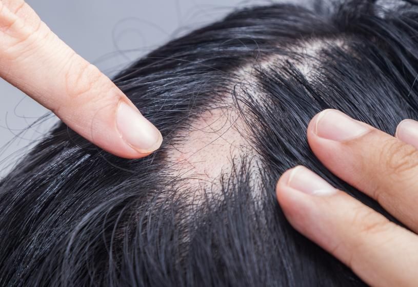 Alopecia areata incognita: 5 risposte al 