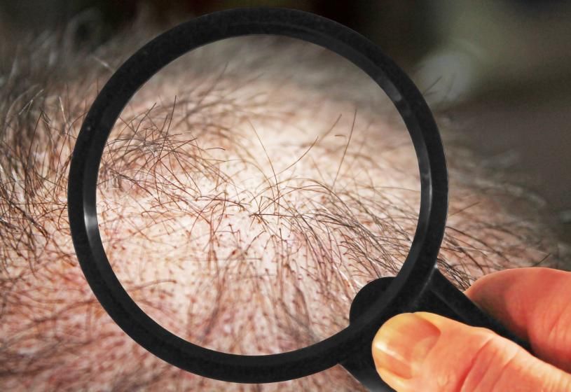 Tricopigmentazione: 5 vantaggi e 5 svantaggi