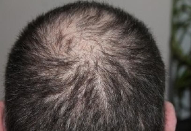 Calvizie precoce: un fenomeno in aumento