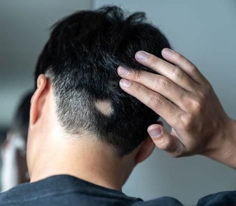 alopecia cicatriziale