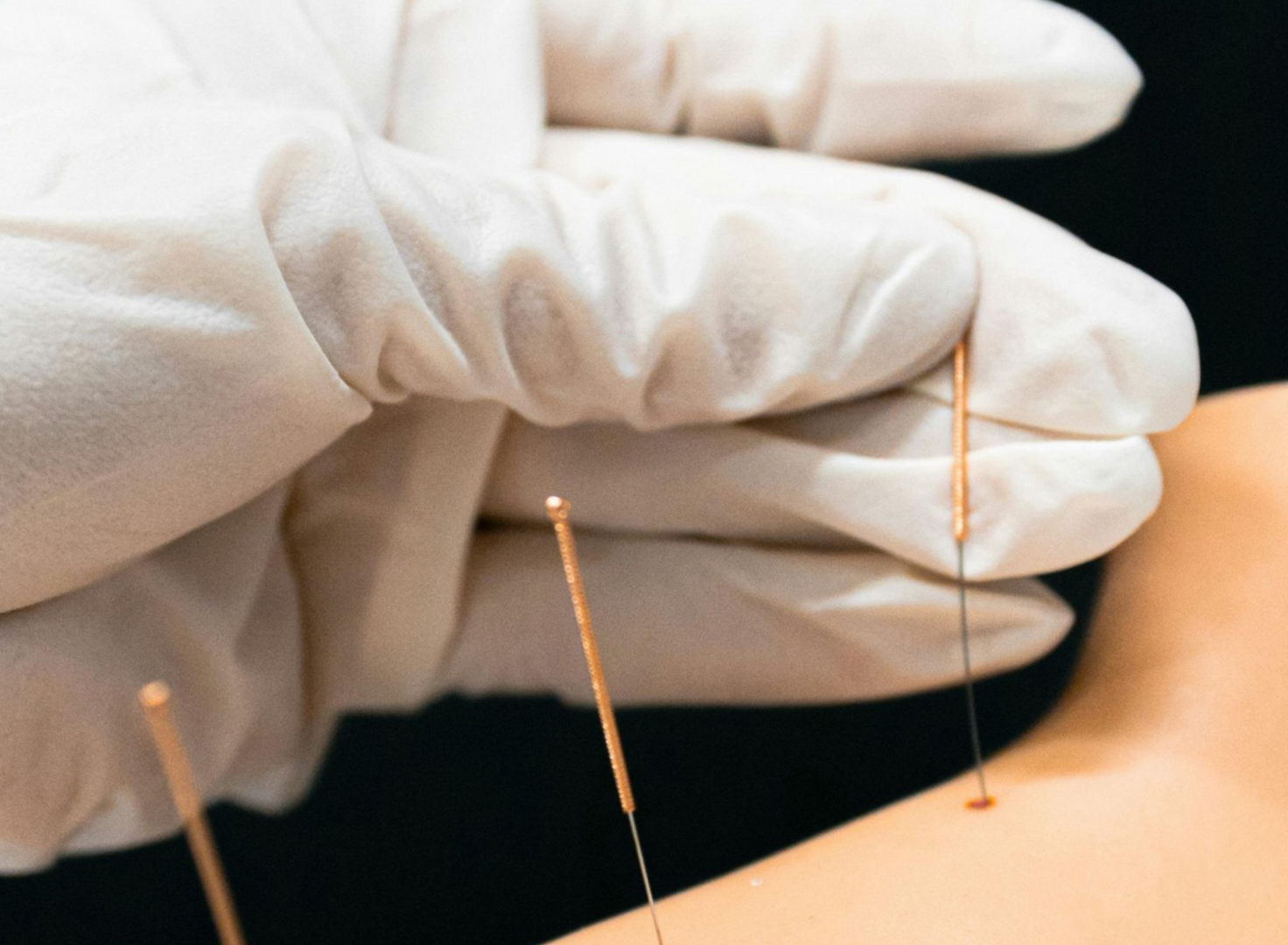 Gloved hand inserting acupuncture needles into a person's shoulder against a black background near Fort Bragg, NC.