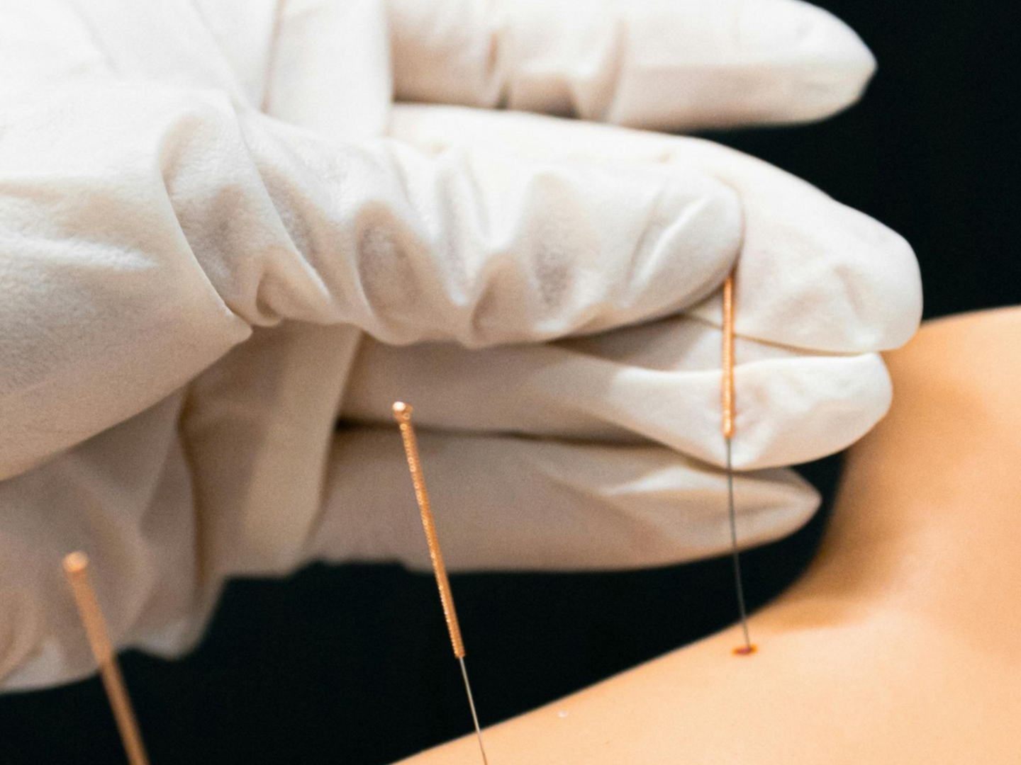 Gloved hand inserting acupuncture needles into a person's shoulder against a black background in Hope Mills, NC.