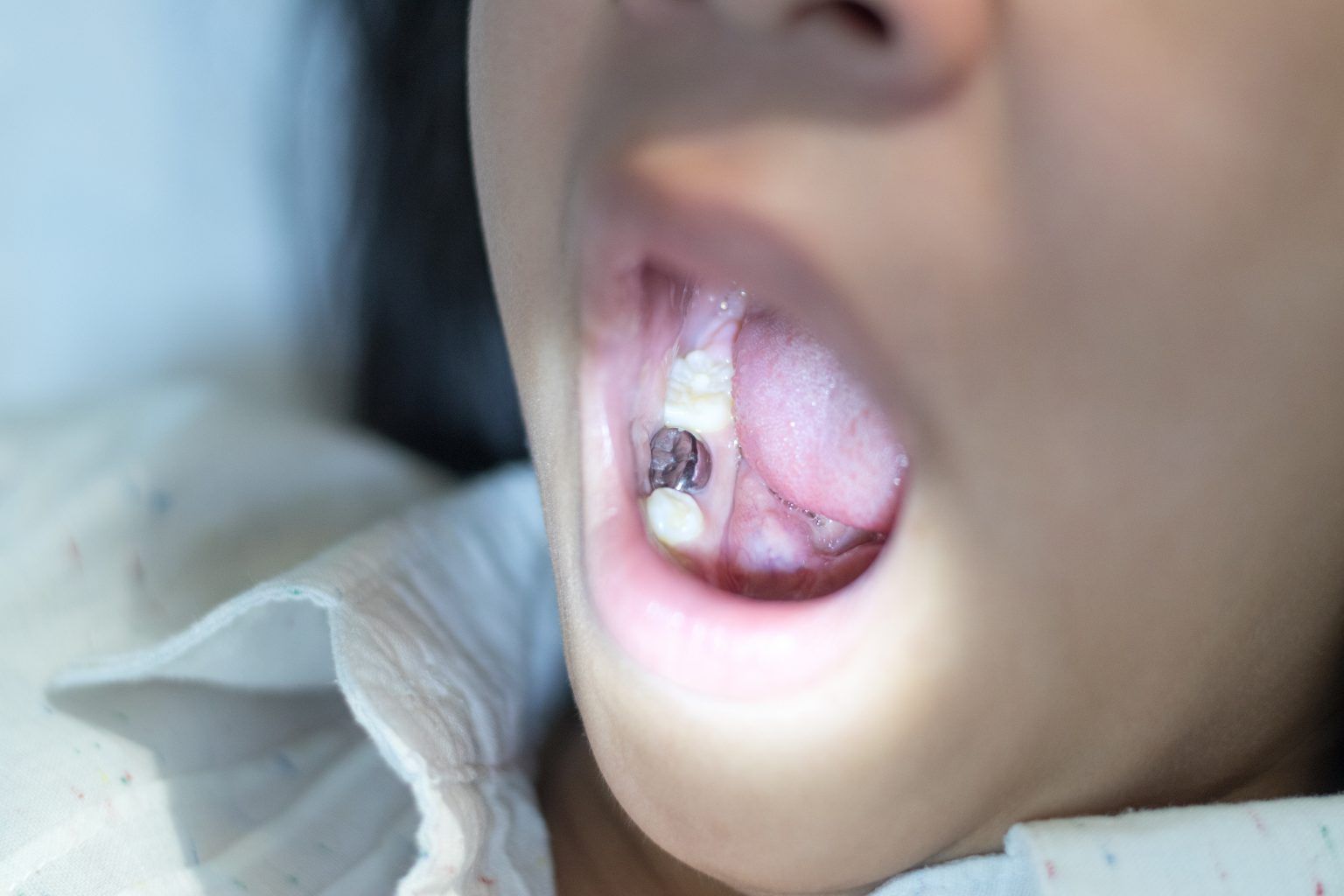 A close up of a child 's mouth with a tooth in it.