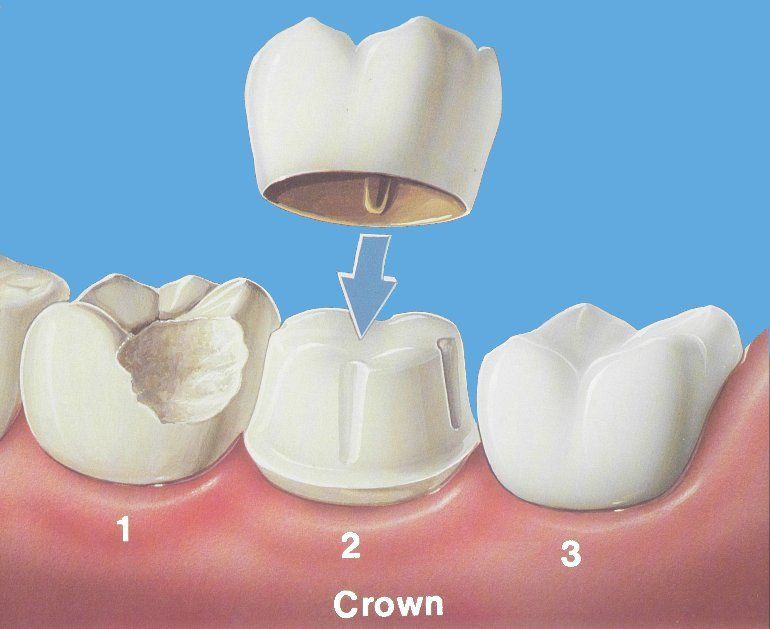 dental crown procedure