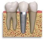 dental implants illustration