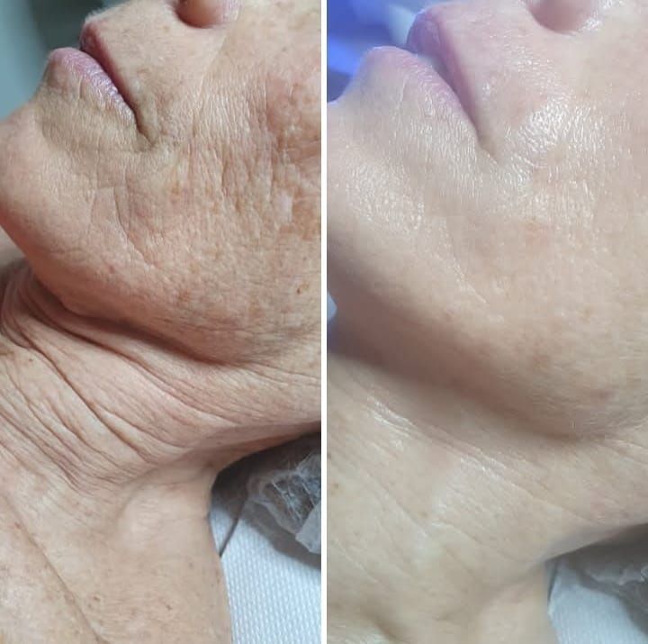 Donna sottoposta a iniezione di filler per le labbra in una clinica; il primo piano mostra l'ago che penetra nel labbro.