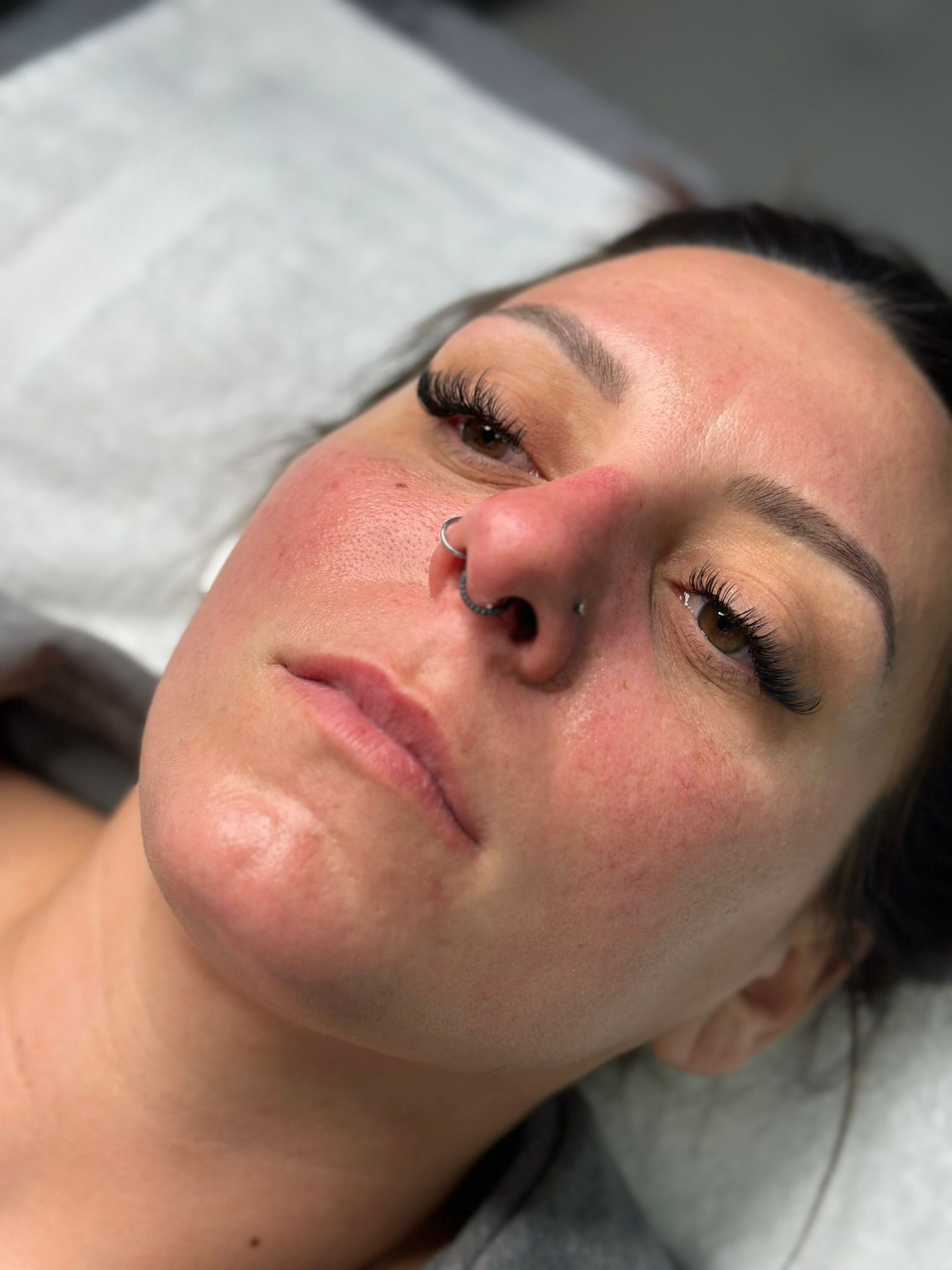 Woman with reddish skin after a facial treatment, lying on a white bed sheet.