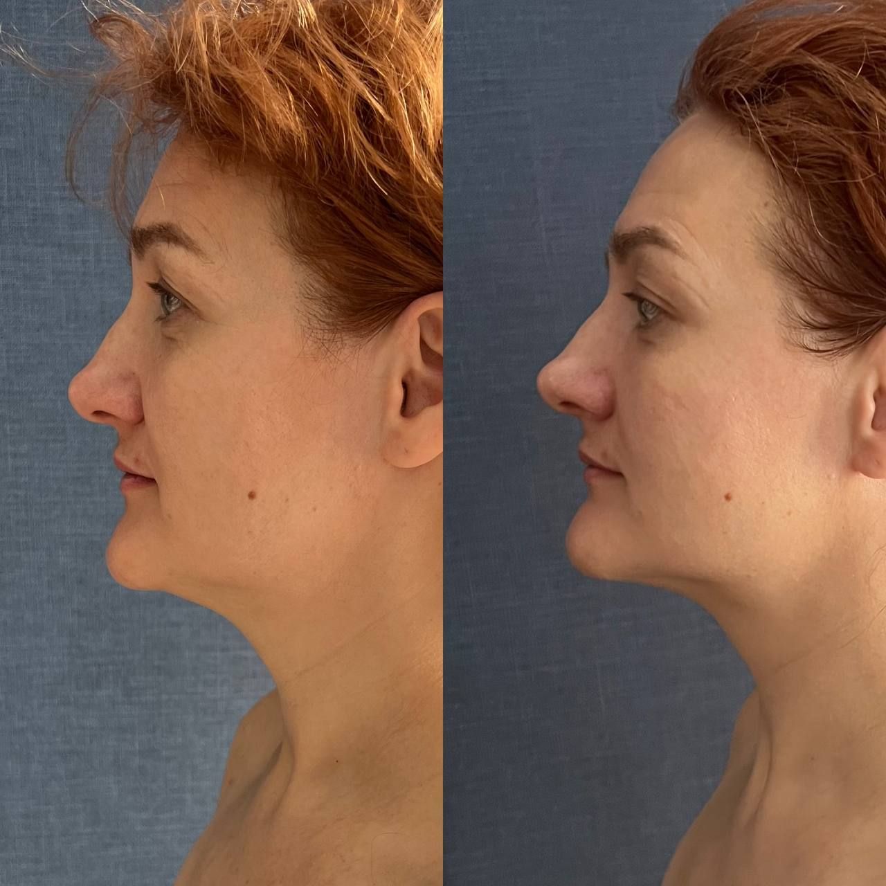 Side-by-side comparison of a person's profile before and after a cosmetic procedure, with a more defined jawline in the 