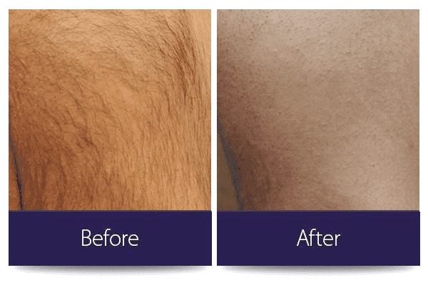 Leg with hair before and after a hair removal treatment.
