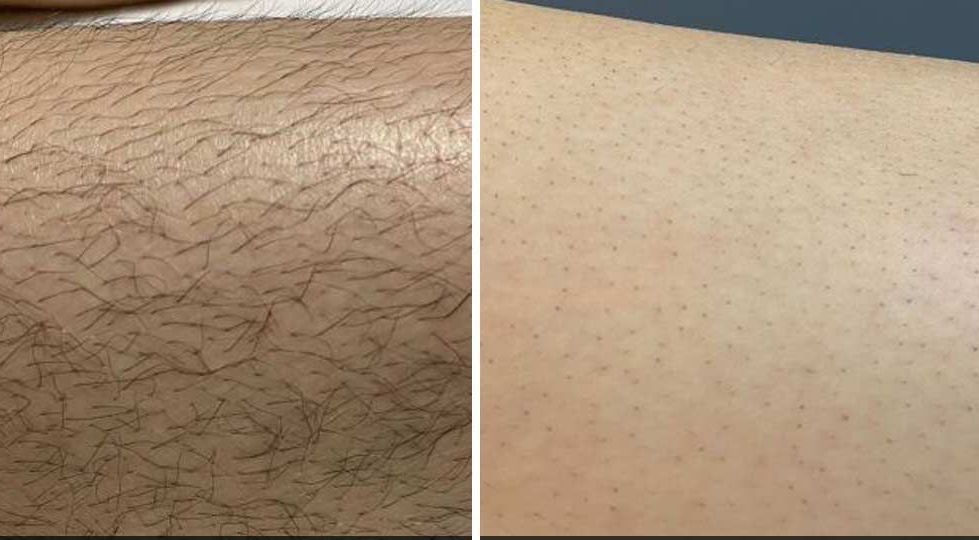 Comparison of a hairy leg (left) and a hairless leg (right), illustrating hair removal.
