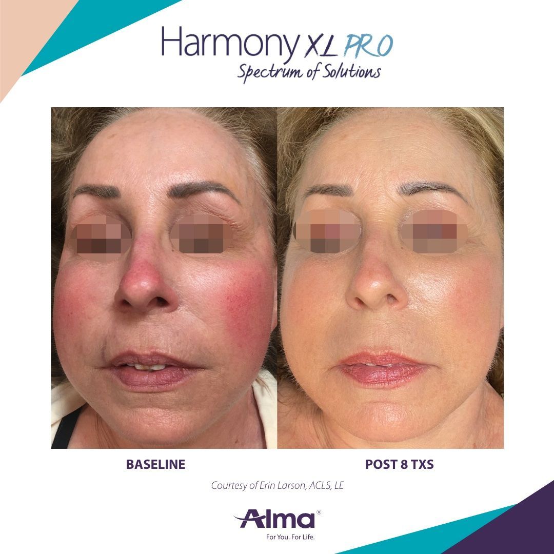 Comparison of a face before and after treatment, reducing redness.