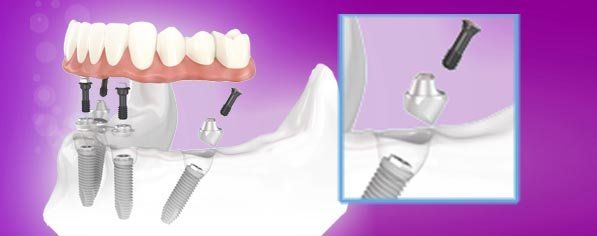 schema fissaggio impianto dentale
