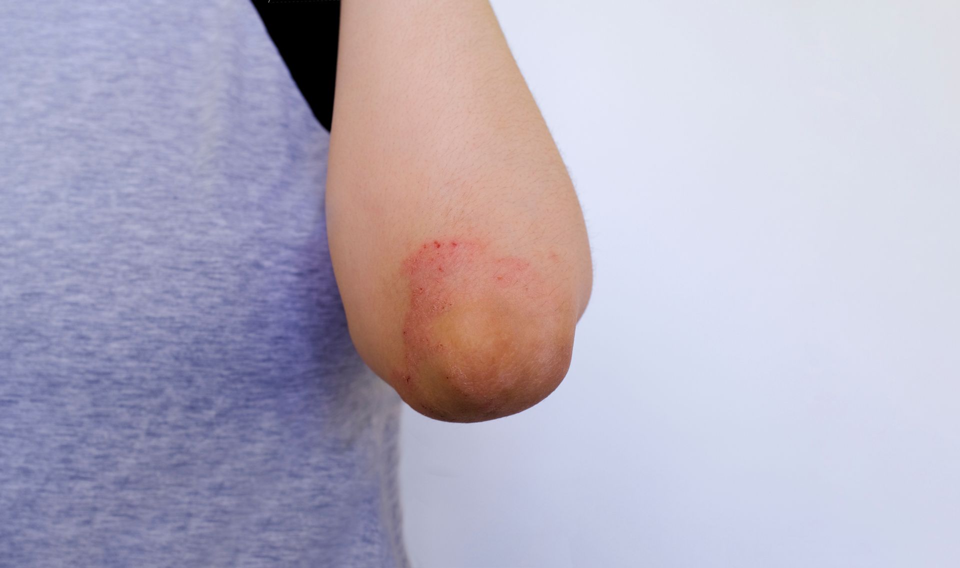 Elbow with red, irritated skin, likely from friction, visible against a gray shirt.