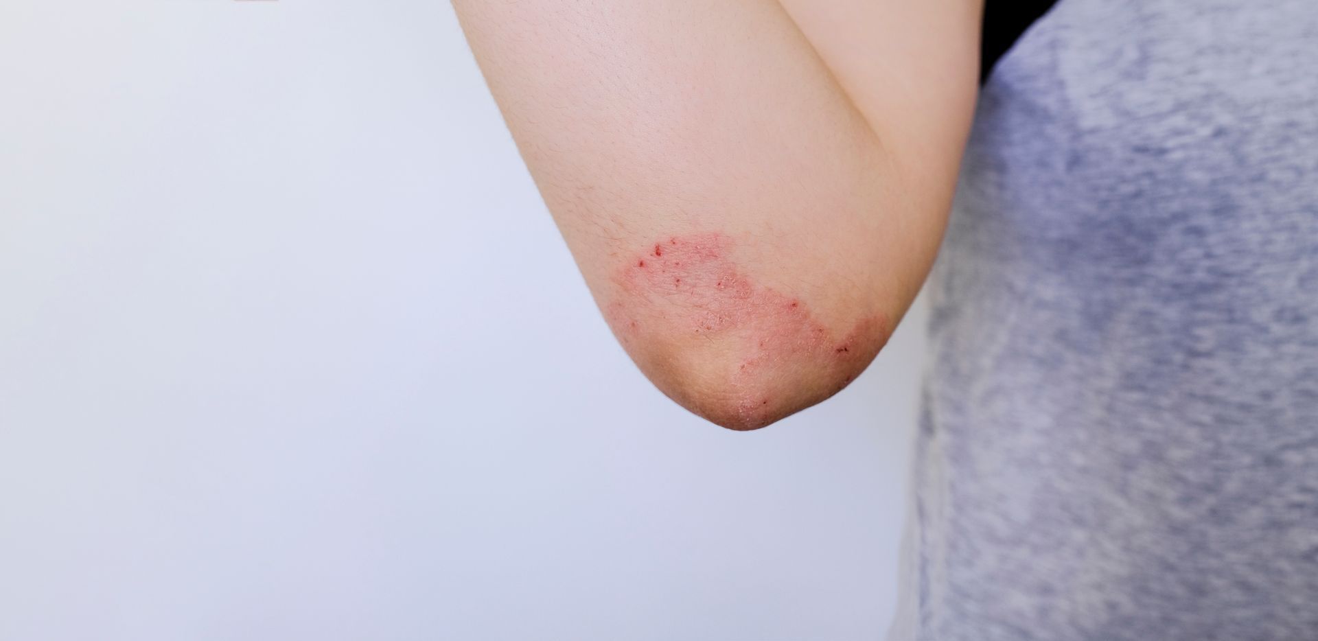 A person's elbow with a patch of red, irritated skin, possibly eczema, against a plain background.