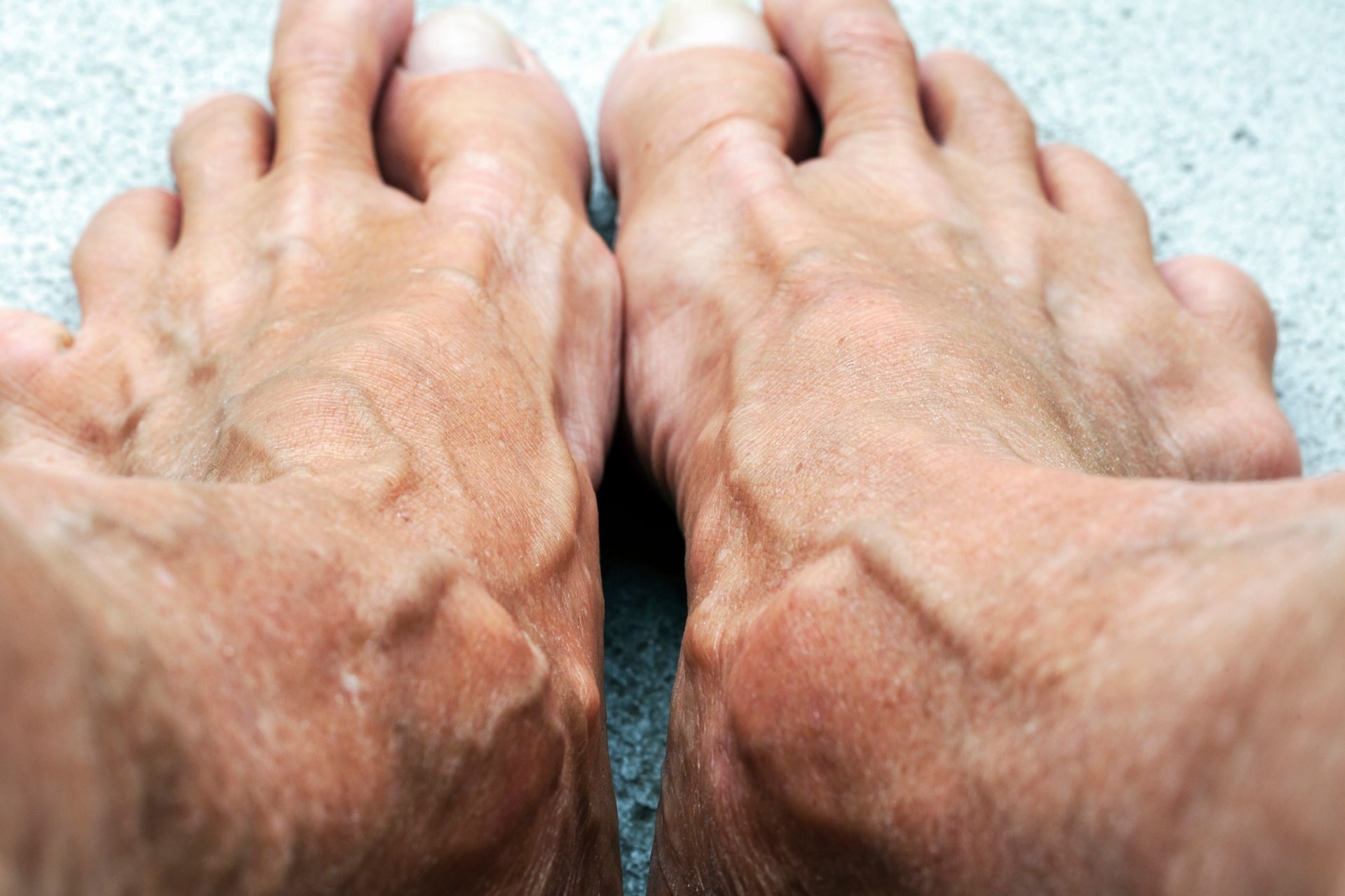 Close-up view of two feet, showing prominent veins on top, with fair skin.