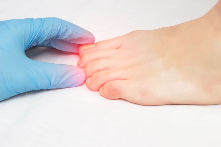 toenail fungus treatments in New Albany, IN