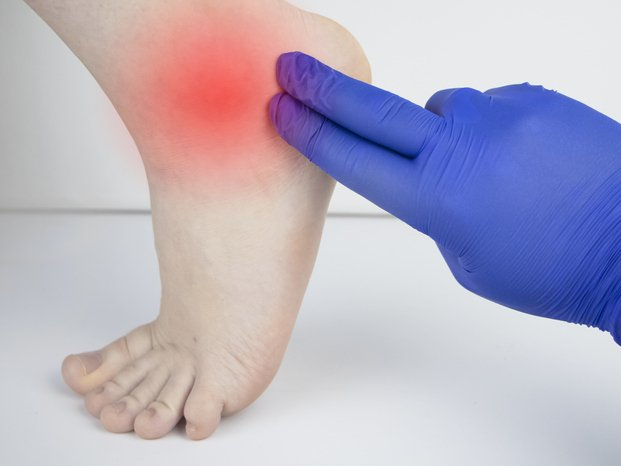 peroneal tendon injury treatment