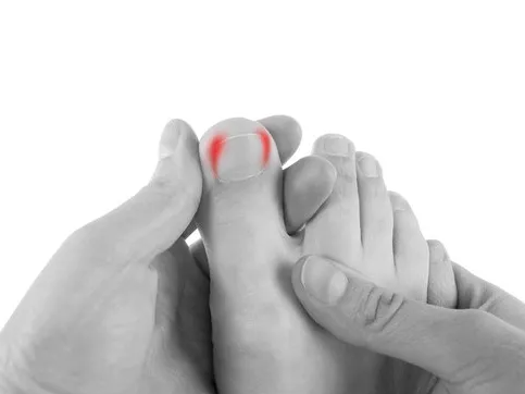 professional ingrown toenail treatment