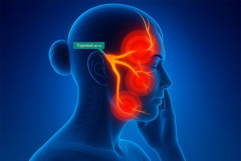 Trigeminal Neuralgia