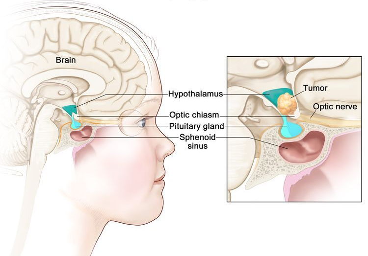 Craniopharyngioma