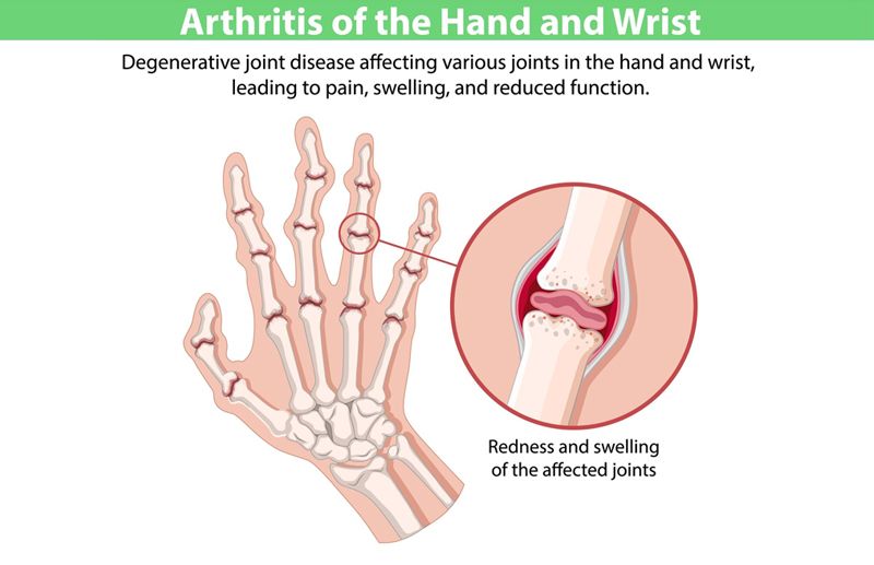 Rheumatoid-Arthritis