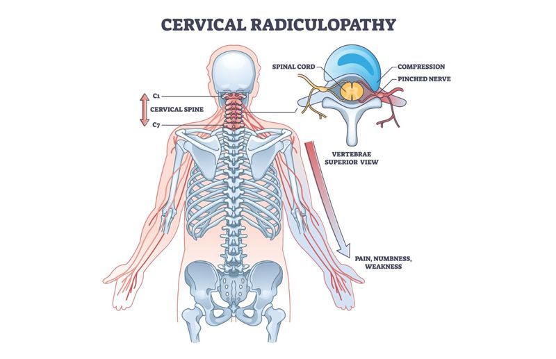 Radiculopathy