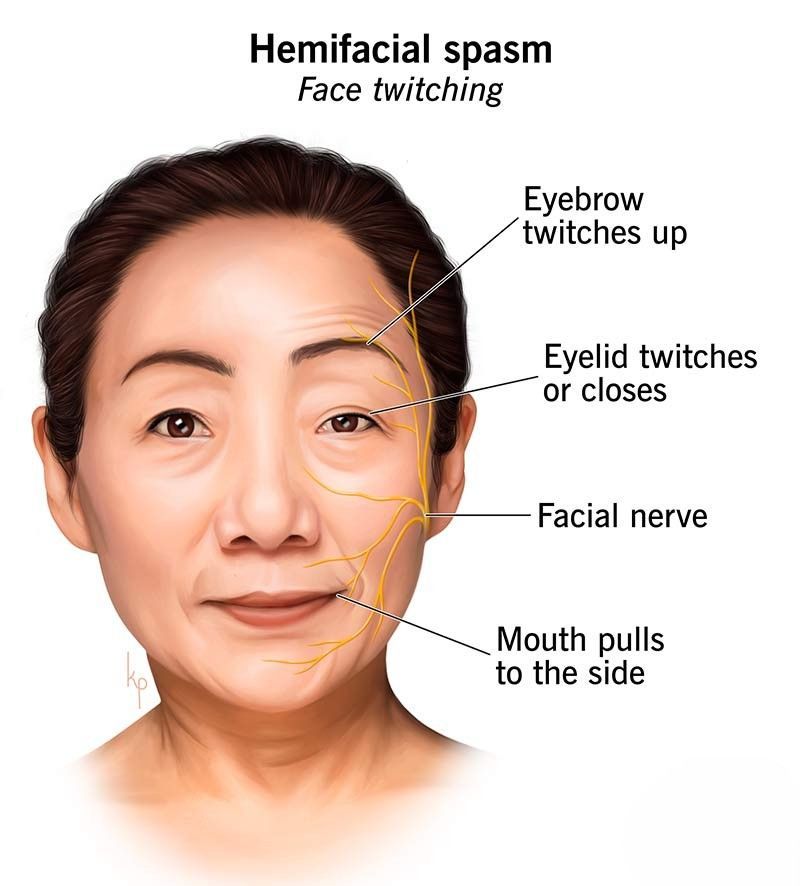 Hemifacial Spasm