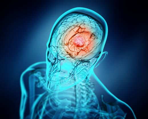 Metastatic Brain Tumors