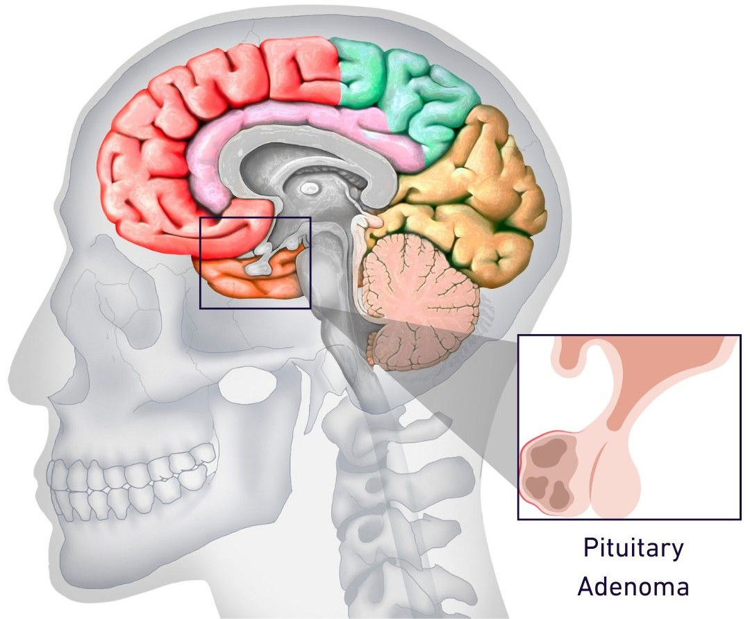 Pituitary Adenoma