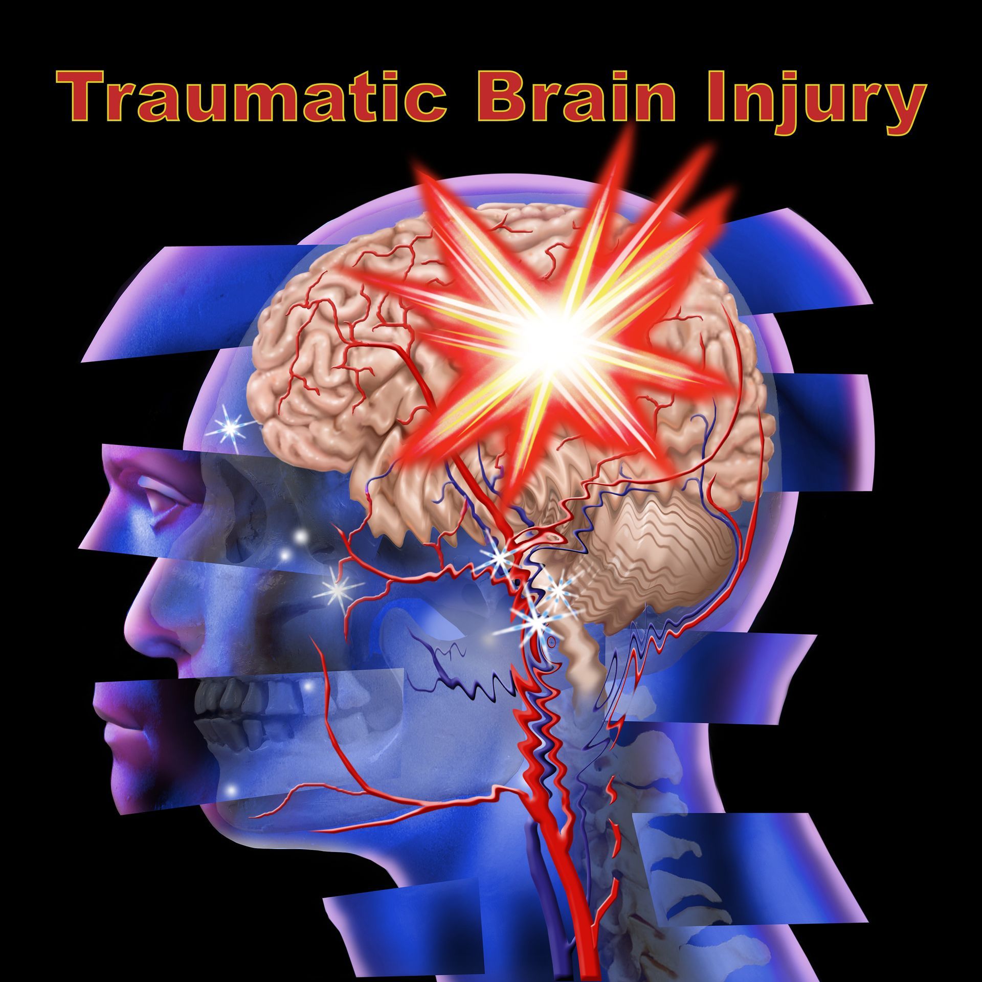 Traumatic brain injury image of skull and impact