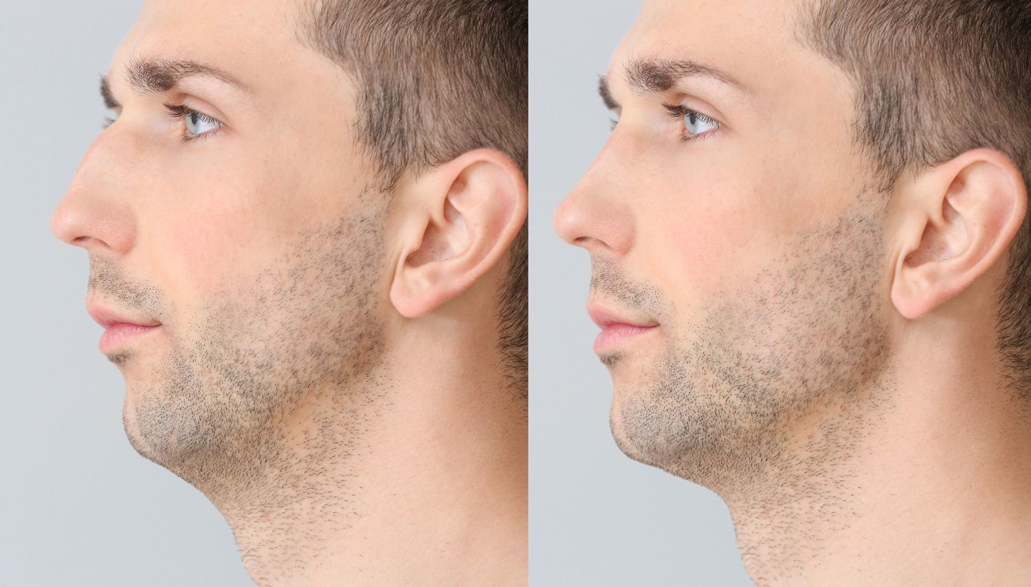 before and after non-surgical nose reshaping