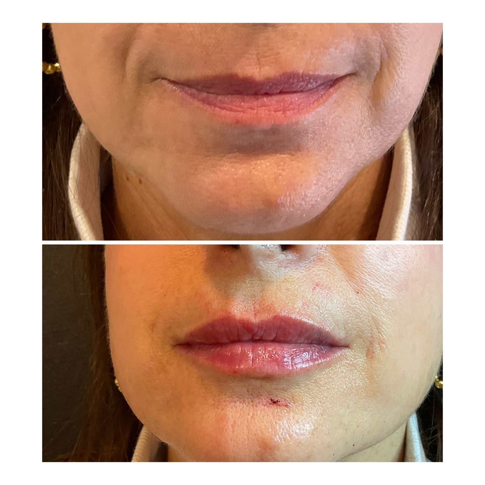 A before and after photo of a woman 's lips.