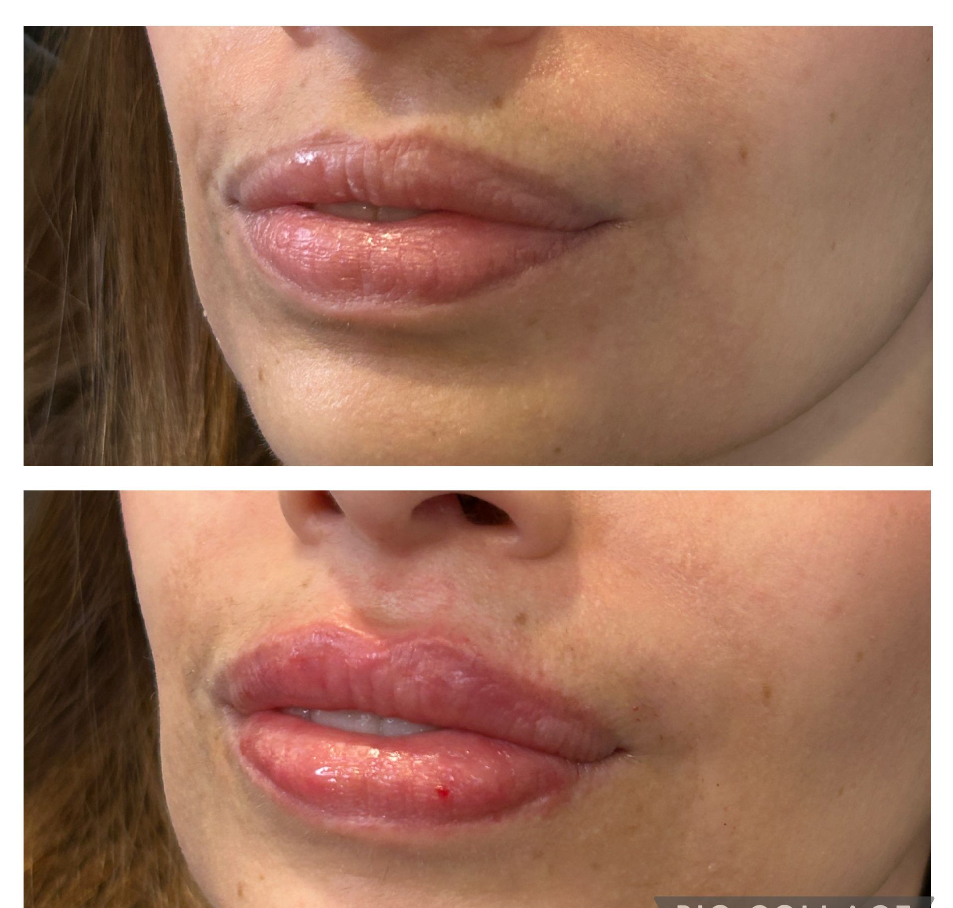 A before and after picture of a woman 's lips.