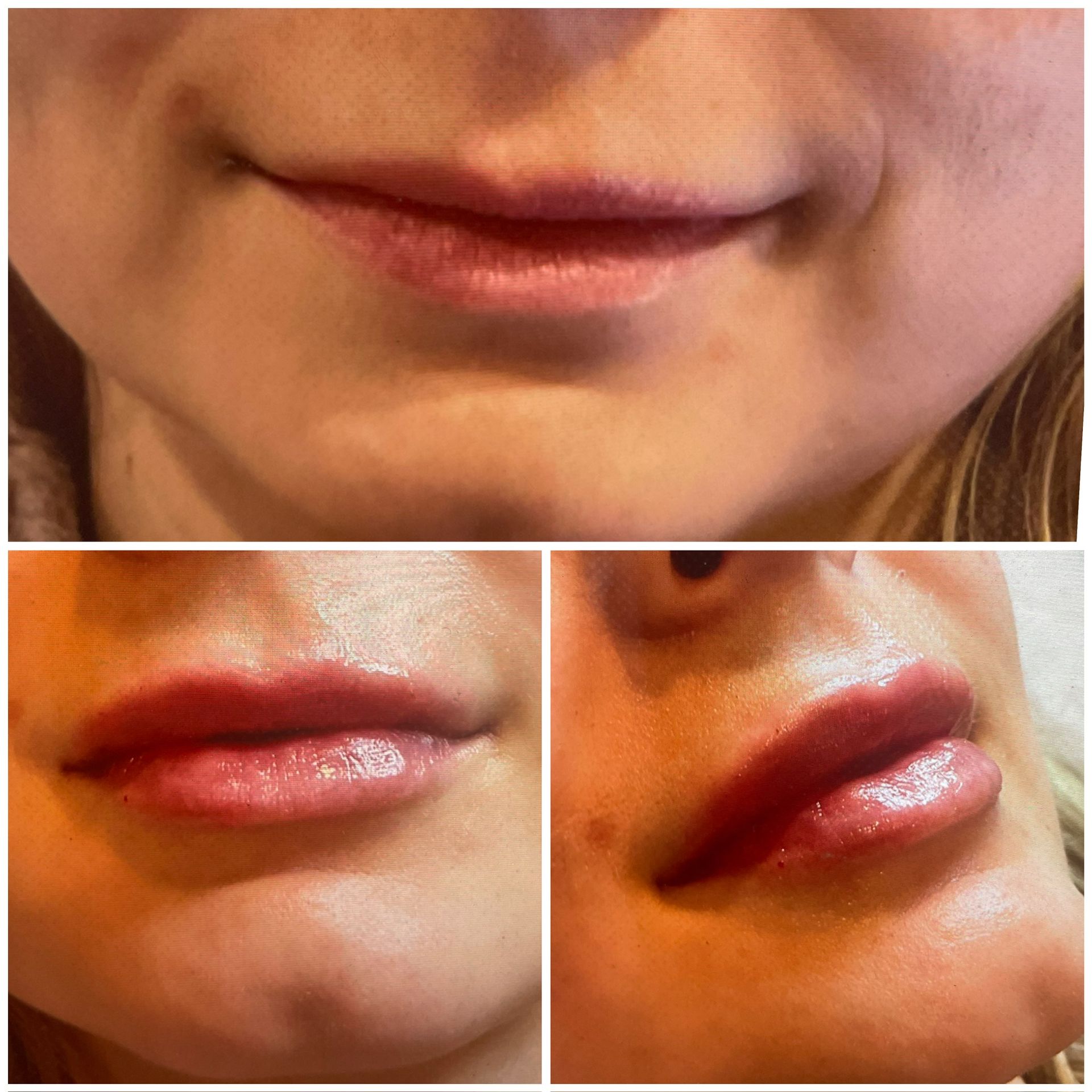 A collage of three photos of a woman 's lips before and after lip injections.