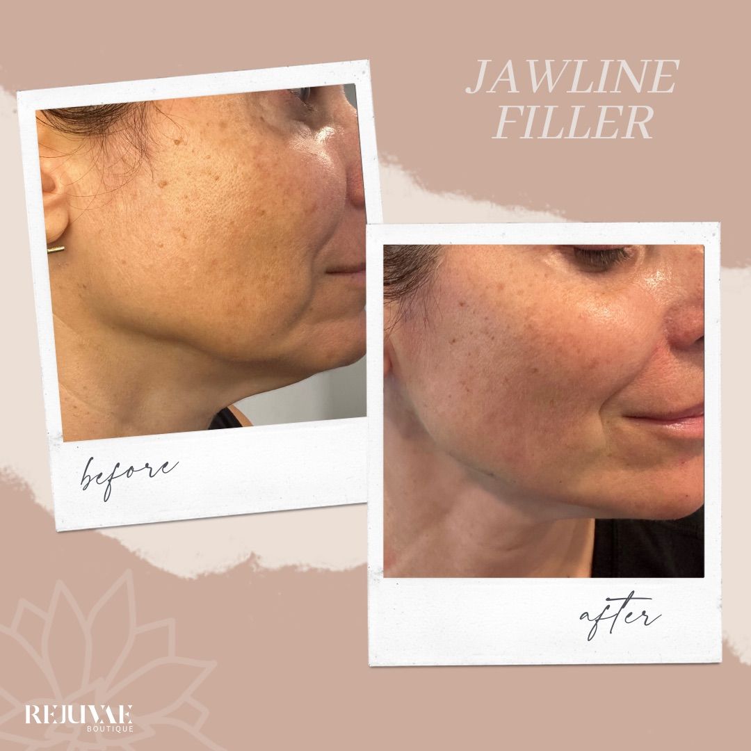 A before and after photo of a woman 's face with a jawline filler.