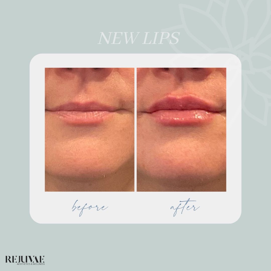 A before and after photo of a woman 's lips.
