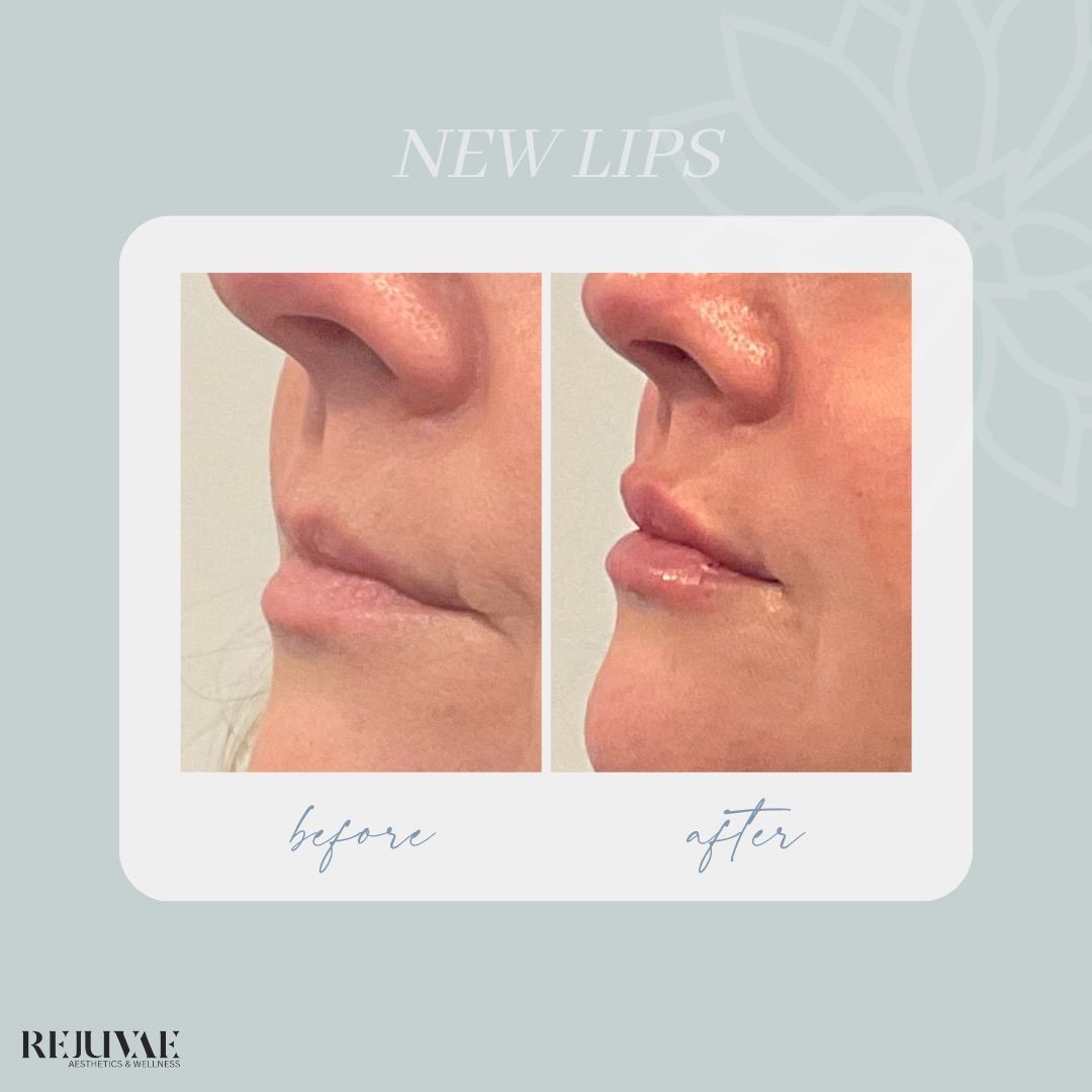 A before and after photo of a woman 's lips.