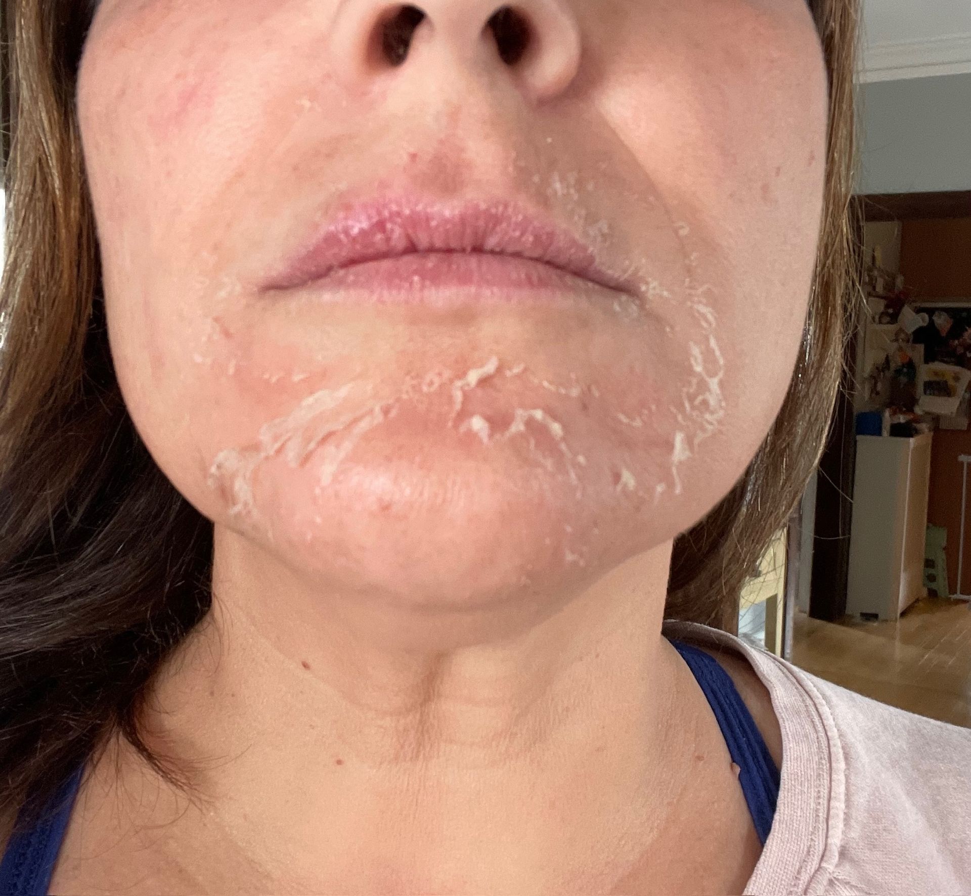 A close up of a woman 's face with peeling skin