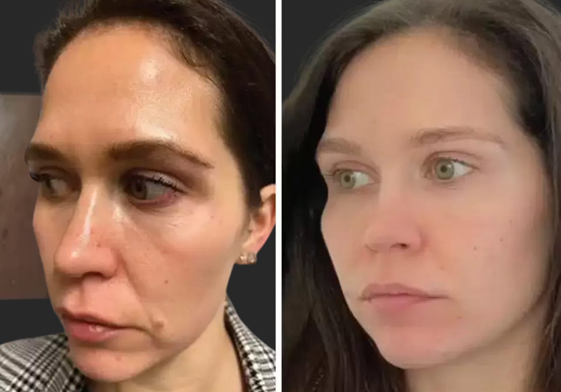 A before and after photo of a woman 's face.