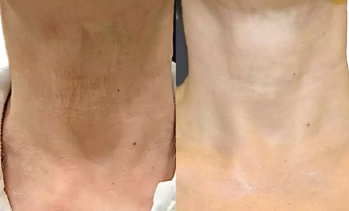 A before and after photo of a person 's neck.